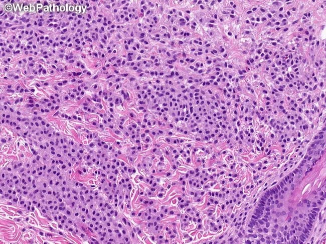 This histopathology image demonstrates a dermatologic mast cell infiltrate associated with urticaria pigmentosa (cutaneous mastocytosis). Acquired lesion is evaluated on a formalin-fixed skin biopsy processed for light microscopy. The section shows dense sheets of round to oval, sometimes spindle-shaped mast cells occupying the superficial to mid-dermis. Individual cells exhibit uniform nuclei with clumped chromatin and moderate eosinophilic to amphophilic cytoplasm; cytoplasmic granules are faintly visible. The overall pattern lacks conspicuous epithelial involvement and displays a perivascular, often diffuse dermal distribution rather than compact clusters. Immunophenotypic context typically includes CD117 (c-KIT) positivity of neoplastic mast cells; aberrant CD25/CD2 expression may be present in some cases of systemic mastocytosis but is not consistently seen in reactive mast cell hyperplasia. In reactive conditions, mast cells are more loosely scattered with a perivascular tendency and are usually CD25/CD2 negative. Clinically, this histology supports a diagnosis of cutaneous mastocytosis when correlated with clinical findings such as pruritus, Darier sign, or urticarial plaques. The image is educational for dermatopathology, pathology residents, and clinicians, illustrating differential considerations with reactive mast cell hyperplasia and mastocytosis. It may guide immunohistochemical workup and subsequent systemic evaluation if warranted. for education.