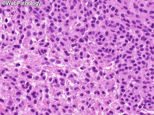 This is a histopathology image of a skin biopsy stained with hematoxylin and eosin, showing a dense dermal mast cell infiltrate consistent with urticaria pigmentosa (cutaneous mastocytosis). The neoplastic mast cells are uniform, arranged in sheets within the reticular dermis, with oval to spindle-shaped morphology and ample eosinophilic or amphophilic cytoplasm containing visible granules. Nuclei are round to oval with clumped chromatin and inconspicuous nucleoli; binucleated cells may be present. Cytologic atypia is not a prominent feature, supporting a benign or indolent mast cell proliferation rather than high-grade disease. The surrounding stroma shows mild edema and occasional inflammatory cells; blood vessels are unaffected. Immunohistochemistry for CD117 (c-KIT) would typically be positive, and toluidine blue or other mast cell stains would highlight granules, confirming mast cell lineage. Clinically, this histology correlates with pigmented, pruritic lesions that characteristically degranulate on mechanical stimulation (Darier's sign). The image captures the key diagnostic features: sheets of uniform mast cells in the dermis, minimal pleomorphism, and absence of marked mitotic activity. This pattern helps distinguish cutaneous mastocytosis from reactive mast cell hyperplasia; however, assessment for systemic involvement (serum tryptase, KIT mutational status, organomegaly) may be warranted in broader clinical contexts.