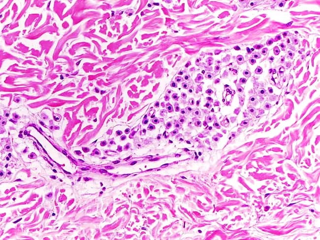 Imaging modality: Light microscopy of a hematoxylin and eosin stained skin biopsy (dermis). The section demonstrates a sparse dermal infiltrate of mast cells in a perivascular distribution within the superficial to mid dermis, adjacent to collagen and small vessels. Mast cells appear as round to oval basophilic nuclei with granulated cytoplasm; the background stroma shows mild edema and mild perivascular lymphocytic inflammation. The infiltrate is not dense, supporting a clinical diagnosis of urticaria pigmentosa (cutaneous mastocytosis) rather than a mast cell proliferation with extensive infiltration. The epidermis is relatively preserved; no pseudoepitheliomatous hyperplasia; no significant fibrosis. Special stains or immunohistochemistry with CD117 (c-kit) or tryptase would enhance confirmation, as normal skin contains few dermal mast cells. Clinically, this histology correlates with pruritus, flush, Darier sign, and pigmentary changes. Diagnostic significance: Supports cutaneous mastocytosis; helps differentiate from pigmented nevi or dermatitis without mast cell infiltration. Differential considerations include other forms of cutaneous mastocytosis, pigmented lesions, and inflammatory dermatoses with inflammatory infiltrates. This image is educational for dermatopathology and histology of urticaria pigmentosa, and can guide workup for systemic involvement if clinically indicated. Terminology: cutaneous mastocytosis; mast cell tryptase testing; KIT mutation assessment may follow.