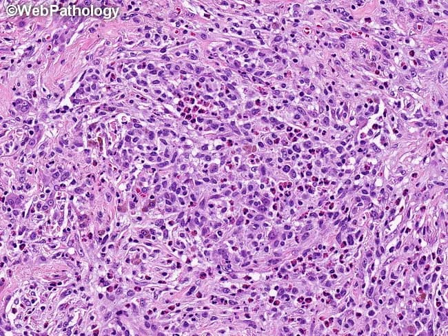 Imaging modality: Histopathology, light microscopy of hematoxylin and eosin (H&E) stained lung tissue. Specimen derived from pulmonary parenchyma via biopsy. Microscopic field reveals cellular interstitial infiltrates containing numerous Langerhans cells with vesicular, grooved nuclei and moderate to abundant eosinophilic cytoplasm, accompanied by eosinophils, lymphocytes, plasma cells, pigment-laden macrophages and occasional neutrophils. Early lesions are cellular with abundant Langerhans cells and eosinophils and minimal fibrosis; later stages show progressive fibrosis and foamy macrophages with reduced Langerhans cell density and fewer eosinophils. Langerhans cells may form cohesive clusters within airspaces and interstitium, sometimes surrounding necrotic debris; Charcot-Leyden crystals may be present in eosinophil-rich microabscesses. The histology may resemble granulomatous inflammation but lacks classic granulomas; immunophenotype is typically CD1a and CD207 (Langerin) positive in diagnostic settings. Diagnostic significance: this pattern is characteristic of pulmonary langerhans cell histiocytosis (PLCH), which commonly associates with smoking and can progress to cystic lung disease; differential includes eosinophilic pneumonia, hypersensitivity pneumonitis, granulomatous infections, and smoking-related interstitial fibrosis. Clinical correlation: correlate with smoking history, respiratory symptoms, and imaging; confirm with immunohistochemistry; assess for complications such as pneumothorax; management focuses on smoking cessation and, in selected cases, targeted therapies. Additional molecular testing may guide prognosis and targeted anti-LCH therapy in cases.