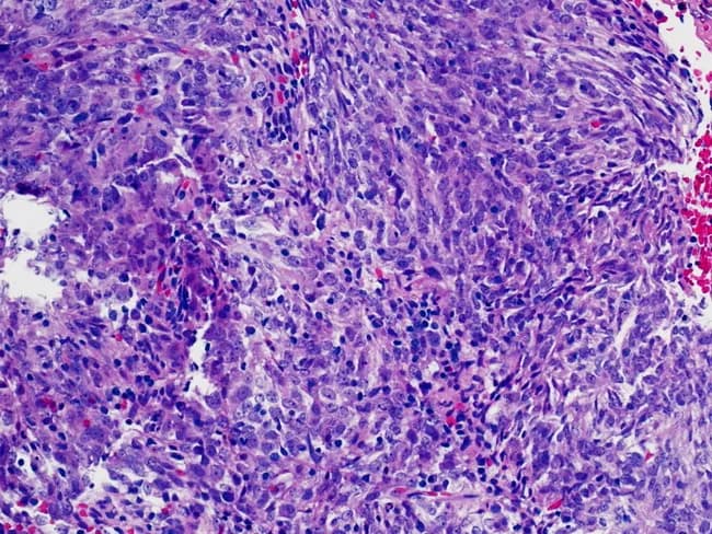 Fine-needle aspiration cytology (FNAC) of an abdominal mass was prepared as a conventional smear and stained with Hematoxylin and Eosin (H&E). The smear is moderately cellular, composed of interlacing sheets and fascicles of spindle-shaped and epithelioid cells with elongated to oval nuclei, finely textured chromatin, and occasional small nucleoli. The cytoplasm is variable, pale to eosinophilic, with occasional binucleation; cells are embedded in a prominent inflammatory background containing lymphocytes and plasma cells, with rare macrophages. Mitoses are infrequent; necrosis is not evident. The overall morphology shows a dendritic cell-like constellation with broad cytoplasmic processes and cohesive clusters that can mimic other spindle cell neoplasms. Immunohistochemistry (performed on ancillary material) reveals strong and diffuse CD21 positivity, supporting a follicular dendritic cell lineage. The cytologic features, together with CD21 expression, favor follicular dendritic cell sarcoma (FDC sarcoma) over other spindle cell tumors such as fibrosarcoma, inflammatory myofibroblastic tumor, sarcomatoid carcinoma, or melanoma variants. Clinically, this diagnosis is important because it informs surgical planning and adjuvant therapy considerations and requires correlative histopathology for definitive confirmation. The image documents cytomorphology with dendritic cell-rich background and immunophenotype concordance; additional markers (CD23, CD35) can increase diagnostic confidence in FDC sarcoma.