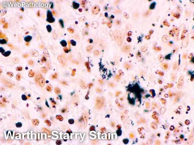 This is a histopathology slide prepared from tissue containing necrotic granulomatous foci, evaluated by bright-field light microscopy after Warthin-Starry silver staining. Primary subject: Bartonella henselae organisms associated with cat-scratch disease; observed organisms are gram-negative, pleomorphic coccobacilli that appear as dark, slightly metallic bodies against a pale hematoxylin-eosin stained background. Staining reveals singular bacteria, small clumps, and occasional chains embedded in necrotic debris within lymphoid or soft-tissue granulomas. The image demonstrates granulomatous inflammation with central necrosis, scattered macrophages, and scant lymphocytes; the bacteria localize to necrotic areas and within macrophages, yielding multiple focal brownish-black deposits. Diagnostic significance: positive Warthin-Starry staining of small, slender bacilli strongly supports cat-scratch disease in the appropriate clinical context, aiding differentiation from tuberculous or fungal granulomas. Synonyms: Bartonella infection, bacillary angiomatosis (distinguish by clinical context and special stains). Differential considerations include non-tuberculous mycobacteria, Nocardia, fungal pathogens, and other intracellular bacteria. Clinical correlation: exposure to cats or kittens, regional axillary or cervical lymphadenopathy, fever, and leukocytosis may accompany histologic findings. Potential clinical use cases: targeted pathogen identification in infectious disease pathology, educational illustration of silver-stain microbiology, and confirmation of granulomatous lymphadenitis due to Bartonella. This image is valuable for teaching, virtual microscopy, and differential diagnosis in infectious pathology.