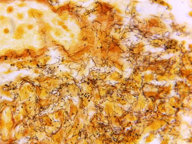This histology image depicts a lymph node section stained with Steiner silver stain, visualizing Treponema pallidum organisms within the node. Light microscopy reveals numerous dark, corkscrew-shaped spirochetes aligned along walls of capsular vessels and scattered through the interstitial stroma, consistent with syphilitic lymphadenitis. The tissue architecture shows preserved lymphoid elements with areas of mild follicular hyperplasia and perivascular inflammation, overlaid by slender, hyaline backgrounds produced by the stain. Steiner silver staining yields high-contrast, fine filaments that stand out against the pale counterstain, enabling direct visualization of spirochetes in situ. Although histology can be variable in syphilis, the detection of multiple organisms strongly supports infection and guides confirmation with serology. This image exemplifies the complementary roles of histopathology, immunohistochemistry, and molecular methods (PCR on lymph node biopsy or fine-needle aspirate) in diagnosing syphilitic lymphadenitis. Clinically, the diagnosis is most reliably established by serologic tests (treponemal and non-treponemal assays) alongside clinical context and patient history. The image is part of the CDC educational collection (Skip Van Orden), serving as a teaching resource for infectious disease pathology, dermatopathology, and surgical pathology workflows in recognizing T. pallidum. This description emphasizes spirochete visualization as a diagnostic clue.