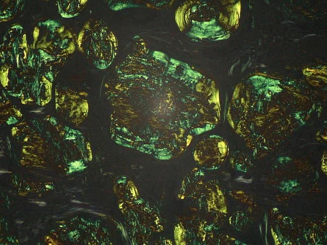 Light microscopy image of a lymph node biopsy stained with Congo Red and examined under polarized light. The tissue reveals extracellular, amorphous eosinophilic deposits distributed throughout nodal architecture consistent with amyloid. The deposits assume a dense, granular to plaque-like appearance on routine brightfield, and demonstrate distinctive apple-green birefringence when illuminated with polarized light, confirming the beta-pleated sheet rich configuration of amyloid fibrils. Congo Red positivity with birefringence distinguishes amyloid from other PAS-positive glycoprotein material and helps differentiate from non-amyloid nodal deposits. The beta-pleated sheet conformation accounts for the characteristic staining behavior and optical properties used in diagnosis. Clinically, identification of nodal amyloid supports systemic or localized amyloidosis and prompts workup for light-chain (AL) or serum amyloid A (AA) subtypes, including serum free light chains, immunofixation, and mass spectrometry-based typing. This image is relevant for educational illustrations of amyloid histology, pathophysiology, and diagnostic pathology workflows, including differential diagnosis with glycoprotein-rich PAS-positive deposits that are Congo Red negative. Potential clinical scenarios include workup of lymphadenopathy in patients with chronic inflammatory states, plasma cell dyscrasias, and lymphoproliferative disorders. High quality images like this support interdepartmental communication, teaching, and reproducible reporting of amyloid histology for junior pathologists and medical trainees in pathology education programs.