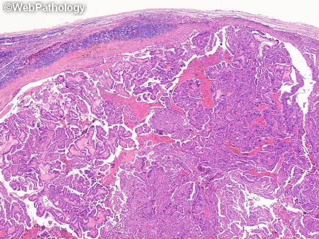 This histopathology image depicts thyroid tissue demonstrating papillary thyroid carcinoma features on bright-field light microscopy after Hematoxylin and Eosin staining. The specimen, a surgical thyroid tissue section, reveals papillary architecture with branching fronds and fibrovascular cores infiltrating the surrounding parenchyma. Tumor cells are columnar to cuboidal with enlarged, optically dense nuclei showing characteristic clearing (Orphan Annie eye), nuclear grooves, and occasional intranuclear inclusions. The nuclear features are conspicuous and serve as the diagnostic hallmark of PTC, distinguishing it from benign thyroid tissue and other malignancies. In many regions, the papillary cores and tumor clusters are surrounded by delicate fibrous stroma, with occasional calcified psammoma bodies that may be present within the papillae. Capsular or lymphovascular invasion may be evident in invasive disease, correlating with higher staging. The image highlights the propensity of PTC to metastasize to cervical lymph nodes, a clinically relevant consideration in surgical planning, neck dissection, and prognosis. This slide also provides a reference for differential diagnosis including follicular variant of papillary thyroid carcinoma, follicular thyroid carcinoma, medullary thyroid carcinoma, and anaplastic/poorly differentiated thyroid carcinomas. Clinically, these histologic features guide treatment strategies and correlate with tumor behavior and patient outcome.