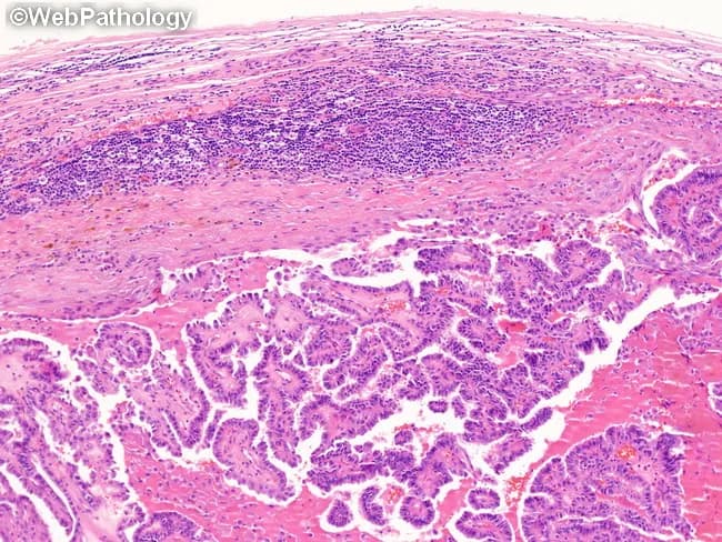 Light microscopy of a cervical lymph node with metastatic papillary thyroid carcinoma. Specimen: Lymph node from the neck region submitted for metastatic carcinoma assessment. The node shows effacement of normal architecture by a papillary thyroid carcinoma metastasis that forms arborizing papillary fronds with fibrovascular cores. Tumor cells display characteristic nuclear features of papillary carcinoma, including optically clear (ground-glass) nuclei, nuclear grooves, and intranuclear pseudoinclusions. The metastatic deposit replaces most of the nodal parenchyma while a rim of residual lymphoid tissue remains at the periphery. Cystic degeneration is frequently observed within metastatic nodal deposits, which can mimic a branchial cleft cyst. Psammoma bodies may be present in some sections. The lesion is typically ipsilateral to the primary thyroid lesion, with possible bilateral involvement in a minority of cases; mediastinal spread is less common. The histology underscores the importance of recognizing PTC features even within lymph nodes to avoid misdiagnosis as benign cystic lesions. Differential considerations include branchial cleft cyst, metastatic squamous cell carcinoma, and other papillary thyroid carcinoma variants. Diagnostic significance includes confirmation of nodal metastasis, staging implications (N stage), and impact on surgical planning and adjuvant therapy. Clinically, this image supports educational, diagnostic, and research use in head and neck oncology, thyroid pathology, and FNA-histopathology correlation.