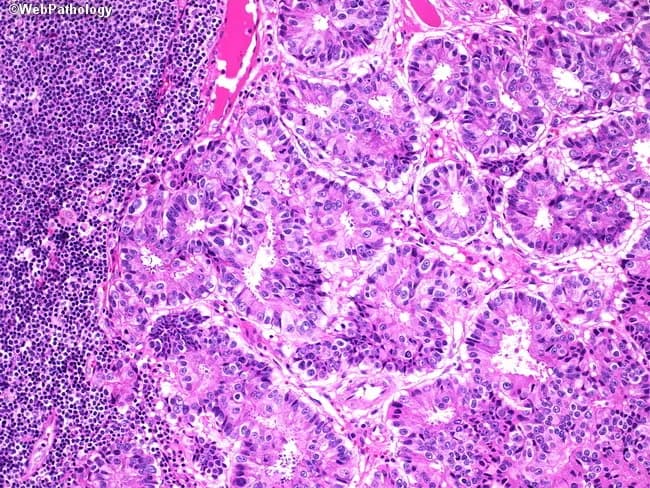 This image depicts a high-magnification bright-field histology slide of a pelvic lymph node effaced by metastatic prostatic adenocarcinoma. The specimen is a paraffin-embedded lymph node section stained with Hematoxylin and Eosin (H&E). Gland-forming malignant epithelial cells infiltrate the nodal parenchyma against a backdrop of residual lymphoid tissue. Tumor glands appear irregular, cribriform or fused, with back-to-back arrangements and desmoplastic stroma. Individual tumor cells show enlarged, hyperchromatic nuclei with conspicuous nucleoli and moderate cytoplasm; nuclear atypia is evident; mitotic activity may be present but not overtly prominent at this field. Lymphoid tissue on the left side remains densely packed with small round cells (reactive lymphocytes), highlighting contrast between neoplastic glands and normal nodes. The architectural invasion into the lymph node supports metastatic spread rather than benign inclusions. Although immunohistochemistry is not shown, prostatic origin is suggested by glandular morphology and is typically confirmed with PSA, PSAP, and NKX3-1 staining. Clinically, nodal metastasis from prostate cancer corresponds to stage N1 and has implications for prognosis and systemic therapy. This image is valuable for education in surgical pathology, oncology, and urology, illustrating the histopathologic hallmarks of metastatic adenocarcinoma in lymphatic tissue and the need for ancillary immunostaining for definitive origin.