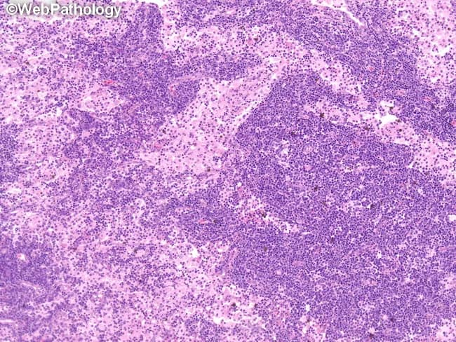 Rosai-Dorfman disease is illustrated by a cervical lymph node specimen in which nodal architecture is markedly effaced by expanded sinusoids filled with abundant pale-staining histiocytes. The histiocytes commonly display large, round to polygonal morphology with ample cytoplasm, and may exhibit emperipolesis, wherein intact lymphocytes or plasma cells are seen within the histiocyte cytoplasm. Hematoxylin and eosin staining produces a pink-purple parenchyma with scattered multinucleated histiocytes and a mixed inflammatory background of lymphocytes and plasma cells. The architectural distortion contrasts with benign reactive nodes and contrasts with Langerhans cell histiocytosis, which lacks prominent emperipolesis. Immunohistochemistry typically demonstrates S-100 protein positivity and CD68 positivity in the histiocytes, supporting the diagnosis together with clinical features. The lesion is usually part of a systemic process; extranodal involvement may occur but massive cervical adenopathy remains a common presentation in pediatric and young adult patients. The image highlights sinusoids expanded by histiocytes rather than neoplastic lymphoid proliferation, suggesting a nonmalignant sinus histiocytosis pattern. Clinically, RDD should be considered in the differential diagnosis of persistent cervical lymphadenopathy with systemic symptoms; differentiate from lymphoma and infectious etiologies. The demonstrated histology is essential for confirming Rosai-Dorfman disease and guiding management and prognosis.