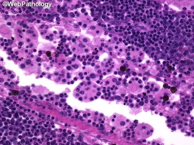 Rosai-Dorfman disease (sinus histiocytosis with massive lymphadenopathy) histology. This light- microscopy image shows a lymph node biopsy with prominent sinus involvement by large histiocytes containing intact lymphocytes and plasma cells within their cytoplasm (emperipolesis). The histiocytes are S-100 positive with abundant pale cytoplasm; non-destructive phagocytosis is evident as clinical hallmark. Erythrophagocytosis may also be present. The surrounding lymphoid paracortex and cortex show a mixed population of small mature lymphocytes and plasma cells, without overt necrosis or significant mitotic activity, indicating benign proliferation rather than malignant lymphoma. The overall architecture of the lymph node is variably preserved apart from the expanded sinuses. Immunohistochemical confirmation (not shown) typically demonstrates histiocytes positive for S-100 and CD68, negative for CD1a, supporting Rosai-Dorfman disease diagnosis. Emperipolesis, although characteristic, is not exclusive to RDD and can be observed in other inflammatory or proliferative conditions. The image is useful for educational differentiation from Langerhans cell histiocytosis, which shows CD1a and langerin positivity and different cellular morphology. This slide exemplifies diagnostic features for pathology residents and hematopathology fellows, complementing clinical correlation of painless lymphadenopathy, fever, and potential extranodal disease. Applications include histopathology teaching, differential diagnosis practice, and research documentation of emperipolesis in nodal tissue for educational use.