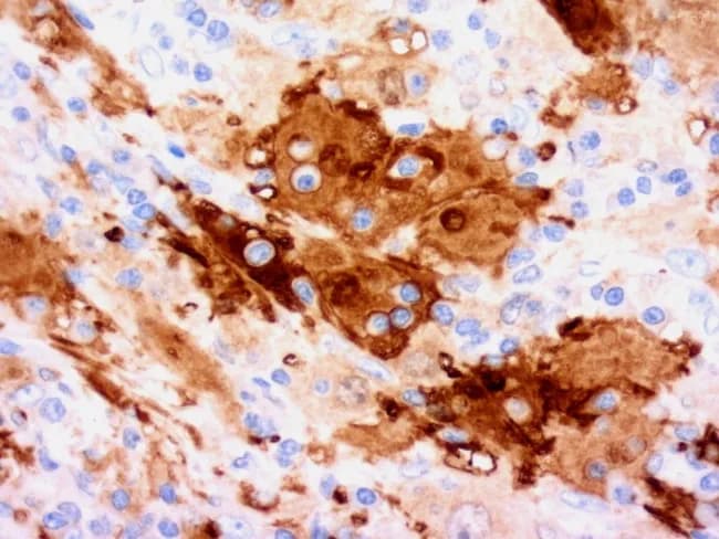 Immunohistochemical micrograph of Rosai-Dorfman disease demonstrating S-100 positive histiocytes highlighting emperipolesis within lymph node–derived tissue. The specimen is prepared as a formalin-fixed paraffin section, stained with S-100 antibody (DAB chromogen) and counterstained with hematoxylin, yielding brown cytoplasmic labeling of histiocytes and blue nuclei in adjacent lymphocytes. Histiocytes are large, with abundant eosinophilic to pale cytoplasm and vesicular nuclei arranged in sinusoids or clusters, and they actively contain intact lymphocytes and plasma cells within their cytoplasm, a feature termed emperipolesis. The immunophenotype is supportive, with S-100 positivity and strong CD68 positivity; CD1a is typically negative or rarely positive, helping distinguish Rosai-Dorfman from Langerhans cell histiocytosis. Additional non-specific markers such as CD4, CD11c, CD14, CD33, CD64, CD163, lysozyme, alpha-1-antitrypsin, and alpha-1-antichymotrypsin may be expressed in histiocytes, whereas CD3 and CD20 are absent in the lesional histiocytes. This image emphasizes the diagnostic hallmark of Rosai-Dorfman disease: emperipolesis by S-100 positive histiocytes. Clinically, this finding supports a nodal lymphohistiocytic disorder with potential extranodal involvement; integration with clinical presentation and imaging is essential for differential diagnosis and appropriate management. Keywords for search include Rosai-Dorfman, sinus histiocytosis, emperipolesis, S-100 positivity, histiocytes, immunophenotype, CD68, CD1a negative, Langerhans cell histiocytosis differential, nodal disease, pediatric/adolescent presentation, extranodal Rosai-Dorfman, DAB immunostain, bright-field microscopy.