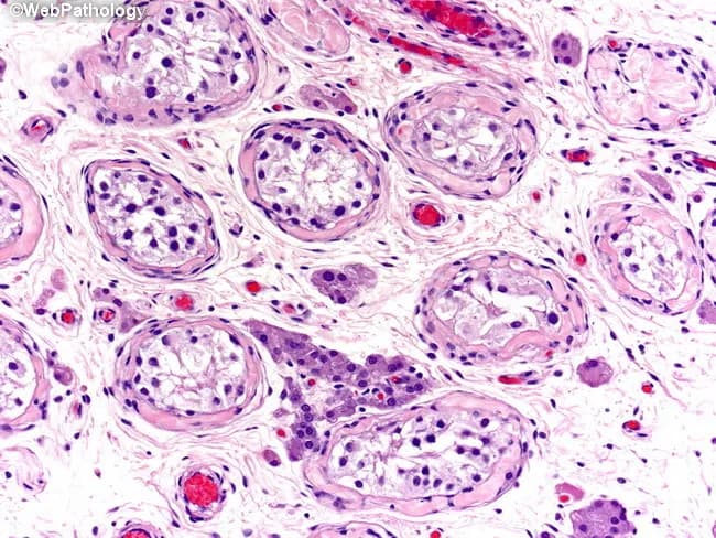 Imaging modality and technique: Light microscopy histology of a cryptorchid testis with splenogonadal fusion. Specimen is gonadal tissue from a testes showing ectopic splenic tissue attachment. The section is a transverse histologic plane stained with Hematoxylin and Eosin (H&E). In this field, seminiferous tubules appear atrophic, with thickened basement membranes and Sertoli cells lining the tubular walls. Germinal epithelium is sparse, and round to elongated nuclei are variably present. Interstitial spaces show clusters of Leydig cells amid fibrous stroma. Overall architecture demonstrates disruption of normal seminiferous tubule integrity, reduced germ cell lineage, and a general paucity of actively proliferating germ cells consistent with cryptorchidism. Accompanying ectopic splenic tissue, a hallmark of splenogonadal fusion, is not readily apparent within the tubules but may be apposed to the gonadal parenchyma in adjacent sections. The pathogenesis involves an early embryologic mis-migration of spleen anlage between week 5 and 8, with later gonadal descent carrying splenic tissue into the testis. Clinically, this histology supports a congenital non-neoplastic anomaly, not a primary neoplasm, and explains potential infertility risk in unilateral or bilateral cryptorchidism. Differential considerations include splenosis, accessory spleen, or heterotopic splenic tissue accompanying the gonad. The image underpins diagnosis, pathophysiology, and surgical decision-making oftentimes.