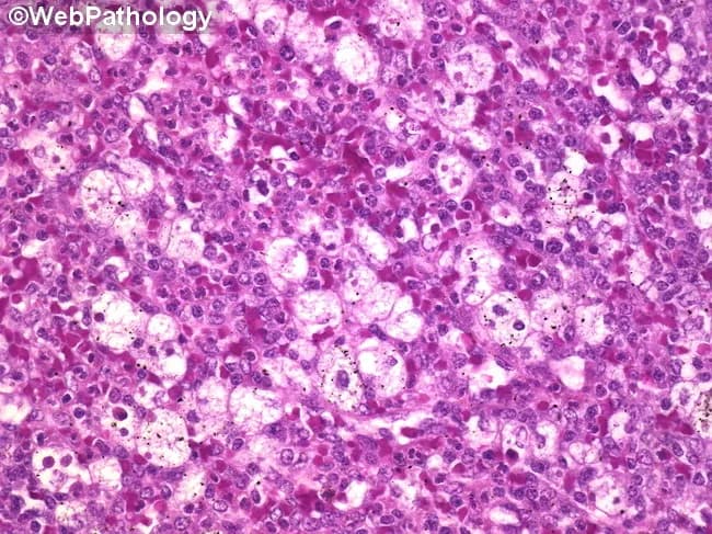 This histopathology image shows splenic red pulp from a patient with immune thrombocytopenia (ITP). Acquired anti-platelet IgG produced largely by the spleen mediates platelet opsonization and clearance, reflected here by aggregates of foamy histiocytes within the red pulp. The foamy appearance results from accumulation of phospholipids within phagocytosed platelets, producing lipid-laden macrophages. In addition, the specimen reveals expansion of splenic white pulp with formation of secondary lymphoid follicles and dilation of sinuses, consistent with a splenic immune/adaptive response. Mild myeloid metaplasia, a known compensatory change, may accompany chronic sequestration of hematopoietic elements. The overall architecture demonstrates prominent macrophagic activity and altered splenic microenvironments that accompany thrombocytopenia. Hematoxylin and eosin staining highlights numerous vacuolated cytoplasmic inclusions in histiocytes and a background of scattered lymphocytes and erythrocytes. Notably, the image emphasizes the pathophysiology of ITP: senescence/ destruction of antibody-coated platelets in the reticuloendothelial system, particularly within the spleen. Clinically, these changes correlate with reduced platelet counts, mucocutaneous bleeding risk, and potential responsiveness to splenectomy. This image is valuable for education on splenic involvement in ITP, macrophage biology, and differential diagnosis with other causes of splenomegaly. The image is suitable for pathology teaching, case review, and research on splenic macrophage dynamics in ITP.