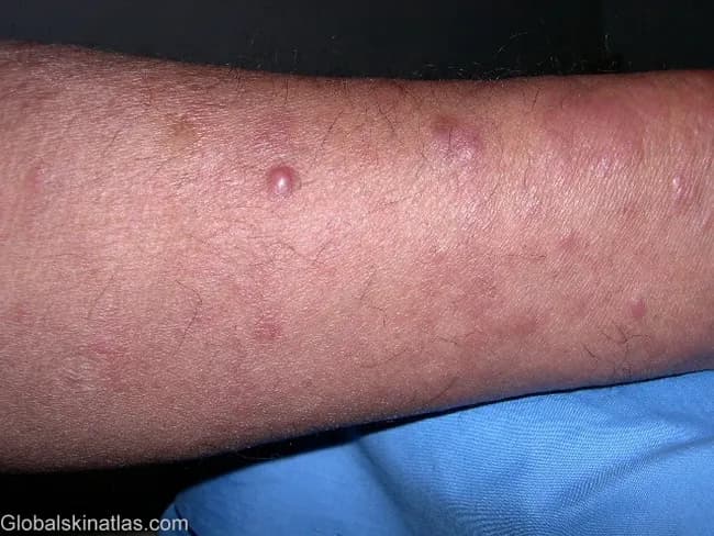 Clinical photograph of skin lesions in lepromatous leprosy. Imaging modality: dermal clinical photography; technique: standard color photograph under ambient lighting; no magnification; no contrast. Anatomical region: forearm skin; laterality not specified; view is a single forearm field. Visual features: generalized reddish-brown, infiltrated papules and nodules with plaques; lesions are densely distributed with some coalescence into larger plaques and surface erythema. The biopsy-proven diagnosis: lepromatous leprosy; histology would reveal diffuse dermal sheets of foamy macrophages (Virchow cells) densely packed with acid-fast bacilli (Mycobacterium leprae). Pathophysiology: infection with M. leprae, an obligate intracellular bacillus that multiplies slowly; prolonged incubation; transmission via close contact; untreated disease causes progressive skin, nerve, limb, and ocular damage. Diagnostic significance: this presentation is characteristic of lepromatous leprosy, a multibacillary form requiring MDT (rifampicin, dapsone, clofazimine). Clinical use cases: educational reference for dermatology, infectious disease, and tropical medicine; aids recognition of diffuse cutaneous involvement, differentiation from tuberculoid forms, and underscores need for early MDT to prevent nerve impairment and disability.