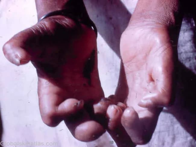 This clinical photograph captures bilateral hands showing claw hand deformity due to early peripheral nerve involvement from tuberculoid leprosy. The flexion contractures of the fingers result from intrinsic muscle wasting (interosseous muscles, thenar, and hypothenar groups) secondary to chronic neuritis with thickened nerves. The palmar aspect highlights impaired intrinsic function with partial lumbrical loss creating a characteristic posture: hyperextension at the metacarpophalangeal joints with flexion of the interphalangeal joints, and evident weakness in grip and dexterity. Nerves involved are classically thickened and tender in Hansen's disease, often involving the ulnar nerve predominantly with contribution from the median nerve. Clinically, this finding signals early sensory-motor neuropathy and potential progression to disability if untreated. The image is a color clinical photograph from Global Skin Atlas, credited to Dr. Ian McColl, illustrating public health relevance of leprosy neuropathy in endemic regions. Notably, the thumbs and other digits may appear relatively spared initially while intrinsic hand muscles disproportionately atrophy. This deformity is important for differential diagnosis against traumatic ulnar neuropathy, diabetic neuropathy, and other causes of clawing. It informs functional prognosis, guides nerve function assessment, and supports educational depiction of Hansen's disease nerve involvement for medical trainees and researchers.