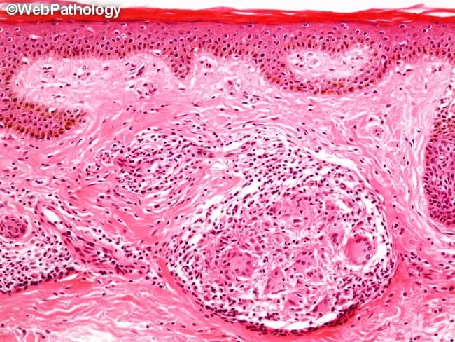 Comprehensive description: Histopathology of a skin biopsy from a cutaneous leprosy lesion prepared with hematoxylin and eosin staining. The dermis and superficial subcutis show non-caseating epithelioid granulomas densely packed around small cutaneous nerve fibers, often forming serpentine contours along nerve courses. Langhans giant cells are present within granulomas, with a predominant lymphocytic infiltrate composed mainly of CD4+ T helper cells, reflecting a robust cell-mediated Th1 immune response. There is no granulomatous zone (Grenz zone) separating the epidermis from the inflammatory infiltrate, and the epidermis itself may show mild involvement. Bacilli are scarce or not detected by routine modified acid-fast staining, consistent with a paucibacillary, tuberculoid form of leprosy. The granulomatous tissue may extend from the dermis into the papillary dermis and occasionally involve the overlying epidermis, though satellitosis around nerve trunks remains a hallmark. Clinically, this pattern correlates with strong protective immunity, limited bacterial burden, and focal nerve destruction or compression by granulomatous inflammation. This image is educational for recognizing neural-centric granulomas in tuberculoid leprosy, differentiating from borderline tuberculoid and lepromatous forms, and understanding how immune status shapes histology. Potential applications include dermatopathology education, differential diagnosis exercises, and correlating histology with therapeutic decision-making in multi-drug therapy regimens for accurate diagnosis.