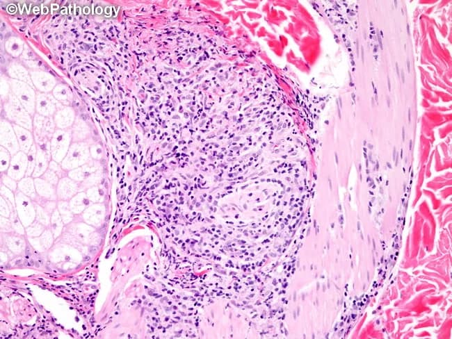 Modality and technique: Light microscopy of a skin punch biopsy from a plaque in borderline lepromatous leprosy was examined with routine hematoxylin and eosin staining and a Wade-Fite acid-fast stain to visualize Mycobacterium leprae. The biopsy demonstrates a dermal and subcutaneous granulomatous infiltrate with nodular architecture and dense lymphohistiocytic crowding. Epithelioid granulomas and foamy (Virchow) macrophages are present, often clustering around small nerves and adnexal structures. Perineural inflammation and thickened nerve trunks are conspicuous, reflecting the clinical finding of palpable thickened nerves. Bacilli are observed inside macrophages, singly or in grape-like globi, on Wade-Fite preparation, confirming infection. The inflammatory pattern is more circumscribed than in classic lepromatous leprosy, yet more numerous lesions and a higher density of lymphocytes distinguish borderline lepromatous disease from tuberculoid forms. Epidermal involvement is minimal; there may be mild interface change without necrosis. The overall histology correlates with a polyclonal, mixed-cell granulomatous response and a propensity to involve cutaneous appendages and nerves. This histopathology supports a Ridley-Jopling borderline lepromatous diagnosis and guides multibacillary treatment decisions, prognosis, and nerve protection strategies. Correlation with clinical features, including symmetrical vs asymmetrical lesions and nerve palsy, improves diagnostic confidence and tailoring of MDT MB regimens. Enhancing educational and research value.