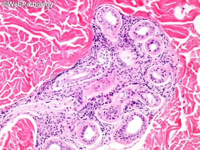 This histopathology image shows a skin biopsy from a patient with borderline lepromatous leprosy. Acquired via light microscopy, tissue sections are stained with Wade-Fite, enabling visualization of acid-fast Mycobacterium leprae bacilli within dermal macrophages and occasionally in association with cutaneous nerves and adnexal structures. The dermal granulomatous infiltrate is nodular and poorly circumscribed with a relatively dense cellular milieu of epithelioid histiocytes, Langhans-type giant cells, and a prominent lymphocytic cuff. Compared with tuberculoid granulomas, BL lesions exhibit increased circumscription of the granulomatous response and greater bacillary load, often forming globi where bacilli cluster within macrophages. The image demonstrates perineural involvement with thickened nerve trunks and bacilli seen singly or in globi within these neural aggregates. Clinically, such histology correlates with numerous skin plaques and nodules, asymmetric distribution, and early sensory impairment. Wade-Fite positivity confirms presence of acid-fast bacilli, distinguishing M. leprae infection from other mycobacterial dermatitis. The diagnostic significance lies in confirming borderline lepromatous leprosy, guiding multidrug therapy, and informing prognosis. Potential educational use includes correlating histology with clinical phenotype, staging within Ridley-Jaworsky spectrum, and emphasizing perineural bacillary invasion. Note: bacillary load and distribution help distinguish BL from LL and are integral to prognosis, disease monitoring, and public health management in endemic regions.
