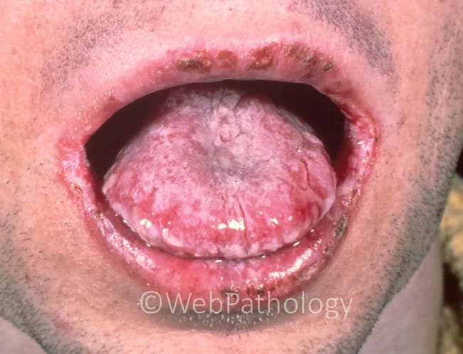 This is an intraoral clinical photograph of a patient with oral candidiasis (thrush). An adherent, white, curd-like pseudomembrane extensively coats the tongue surface (dorsum and lateral margins) and is removable with gentle scraping, exposing erythematous, friable mucosa beneath. The tissue appears inflamed with mucosal glossitis and reduced turgor at the tongue base; the white plaques may extend to the buccal mucosa. In addition, the lips show areas of erosion and crusting consistent with traumatic or infectious mucosal damage that can accompany candidal infection or secondary bacterial superinfection. The image demonstrates characteristic features of pseudomembranous candidiasis: cottage-cheese-like plaques, positive scraping test, and mucosal erythema. Clinical significance: this presentation is typical in immunocompromised individuals, diabetics, antibiotic or inhaled corticosteroid users, the elderly, or patients with HIV/AIDS; suggests need for antifungal therapy (topical nystatin/clotrimazole or systemic fluconazole) and evaluation of underlying risk factors. Potential differential diagnoses include oral leukoplakia (non-scrapable white patch), erythematous candidiasis, aphthous ulcers, or herpes stomatitis; correlation with systemic symptoms and immune status is advised. This image is useful for educational illustration of thrush morphology, scraping test, and mucosal involvement in the oral cavity. Documented features support prompt clinical management and targeted laboratory evaluation as indicated for patient safety and care.