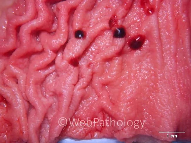 Macroscopic gross pathology photograph of the stomach obtained at autopsy showing multiple gastric ulcers within the mucosal surface. The gastric mucosa is reddened and edematous with irregular, shallow to deep ulcers distributed along the greater curvature and body, separated by residual folds. Several ulcers exhibit dark, coalescent centers consistent with hemorrhagic necrosis; surrounding mucosa appears friable and inflamed. In the clinical context of disseminated candidiasis in a patient with cirrhosis, these ulcers likely reflect fungal invasion with microabscess formation, ischemic injury, and inflammatory response. The image provides a luminal surface view with a 1 cm calibration bar for scale. The pattern of gastric involvement may accompany similar lesions in the liver, spleen, and other gastrointestinal segments as part of systemic candidiasis. The macroscopic appearance supports a diagnosis of infectious gastroenteritis secondary to hematogenous seeding by Candida species, particularly in immunocompromised or severely ill individuals. Correlation with histopathology would reveal yeast forms, pseudohyphae, and abscesses within the mucosa or submucosa and granulocytic infiltration. Clinically, this finding is significant due to the high mortality of disseminated candidiasis in cirrhotics, requiring prompt antifungal therapy and systemic workup. Differential diagnoses include peptic ulcer disease, ischemic gastritis, stress ulcers, and bacterial/GI fungal infections.