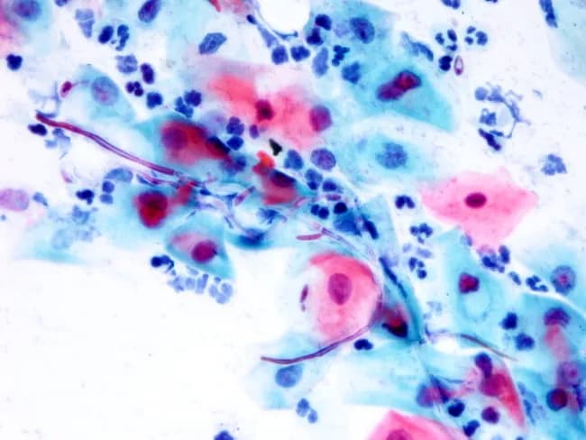 Conventional Pap smear cytology of a cervicovaginal sample stained with Papanicolaou stain. The smear demonstrates abundant squamous epithelial cells with clusters of intermediate and superficial cells. Within these cell clusters there are numerous oval budding yeast forms measuring 1–2 μm and filamentous pseudohyphae; the pseudohyphae are eosinophilic and stain unevenly, extending between cells and forming short branches. A prominent neutrophilic inflammatory component is present. The yeast elements and pseudohyphae are characteristic of Candida species (most commonly Candida albicans) causing vulvovaginitis or cervicitis in appropriate clinical settings. These features differentiate from non-filamentous yeasts and from malignant cells, and are best corroborated by clinical symptoms (pruritus, discharge) and culture or adjunct studies. Diagnostic significance lies in identifying fungal infection with inflammatory response; differential diagnoses include other Candida species, other yeasts lacking pseudohyphae, bacterial superinfection, or non-infectious causes of inflammation. The specimen shows no cytologic evidence of neoplasia. This image is useful for education on fungal cytology, diagnostic verification of candidiasis in cervical/vaginal cytology, and correlates with antifungal therapy planning. Clinicians should consider repeat smear or culture if symptoms persist despite therapy. Pathologic correlation: Candida infection; fungal morphology; budding yeast; pseudohyphae; neutrophils; cervicovaginal candidiasis.