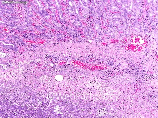 Histopathology of gastric tissue in an immunocompromised patient demonstrates invasive mucormycosis with extensive submucosal necrosis. The slide, prepared from a gastric biopsy, was stained with Hematoxylin and Eosin and examined under light microscopy at multiple magnifications. The architecture shows preserved mucosal remnants overlying a broad zone of necrosis within the submucosa, with heavy inflammatory infiltrate and hemorrhagic extravasation. Within the necrotic stroma, wide, ribbon-like hyphae consistent with Mucorales are seen: irregular, non-septate to pauci-septate filaments with broad diameter and occasional right-angle branching. Vascular invasion is suggested by fungal elements in vessel walls and associated thrombosis, contributing to tissue ischemia. The surrounding gastric mucosa exhibits ulceration and edema, while adjacent serosa and deeper layers may be involved in advanced disease. The image conveys the fulminant, angioinvasive nature of this fungal infection, emphasizing the diagnostic importance of recognizing characteristic hyphae morphology and tissue necrosis in immunocompromised hosts. Clinically, gastric mucormycosis carries high mortality and requires prompt antifungal therapy (liposomal amphotericin B) and surgical debridement when feasible. This histology supports the diagnosis, guides urgent multidisciplinary management, and serves as an educational reference for pathology trainees and researchers studying invasive fungal disease in the gastrointestinal tract.