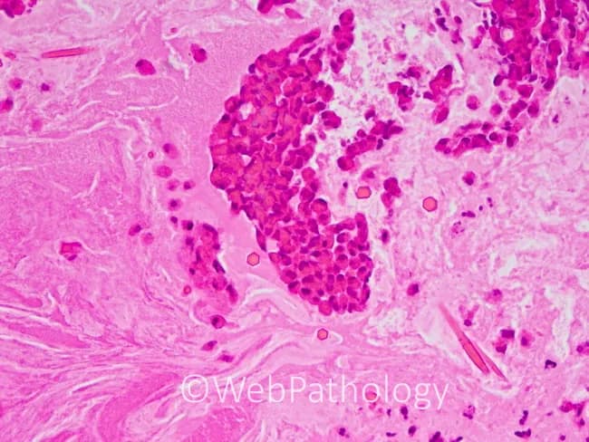 This slide shows a para-nasal sinus mucin specimen examined by brightfield light microscopy after Hematoxylin and Eosin (H&E) staining. The specimen is thick, rubbery, gelatinous, with a greenish-brown coloration typical of allergic mucin. Microscopically, the material is largely amorphous and chondroid-like, may display laminated architecture, and contains clusters of inflammatory cells within a proteinaceous matrix. The inflammatory infiltrate is eosinophil-predominant, with scattered neutrophils, plasma cells, and histiocytes. Charcot-Leyden crystals are frequently present, reflecting eosinophil breakdown, together with desquamated respiratory epithelial cells. Rare fungal hyphae are visible at the upper left and lower right corners of the field, consistent with a minority fungal component without evidence of tissue invasion. The surrounding sinus mucosa shows inflammatory exudate and mucinous debris. Collectively these features support allergic fungal rhinosinusitis (AFRS) with eosinophilic mucin rather than invasive fungal rhinosinusitis or bacterial rhinosinusitis. Diagnostic significance includes recognition of AFRS by eosinophilic mucin with Charcot-Leyden crystals and sparse hyphae, aiding differential diagnosis against chronic rhinosinusitis, fungal ball, and invasive disease. Clinically, findings correlate with chronic nasal obstruction, allergic rhinitis, and asthma; educational and research relevance spans rhinology, otolaryngology, pathology, and radiology. Morphologic features include laminated mucin, eosinophil-rich debris, and occasional contact with respiratory epithelium. Important for education.