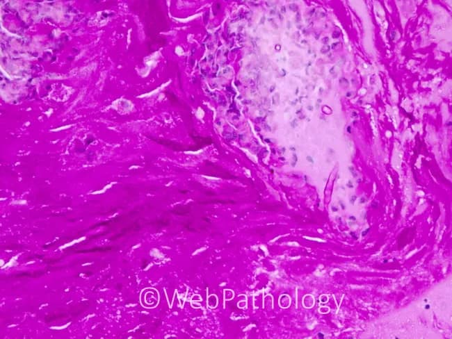 Modality and technique: Light microscopy of a paranasal sinus mucin biopsy stained with Periodic acid–Schiff (PAS). The specimen shows thick, eosinophil-rich allergic mucin containing discrete, pigmented fungal hyphae consistent with dematiaceous organisms. Hyphae are septate with acute-angled branching, noninvasive within the mucus rather than invading sinus mucosa. The pigment imparts a brown-black coloration to the hyphae, typical of Bipolaris species. No tissue invasion or necrosis is evident. The surrounding stroma demonstrates an inflammatory milieu with eosinophils, Charcot-Leyden crystals, and mucus with sparse inflammatory cells. The microbiologic appearance is consistent with allergic fungal sinusitis (AFS) rather than invasive mycosis. The case highlights Bipolaris as the causative agent among dematiaceous fungi such as Bipolaris, Exserohilum, Curvularia, Alternaria, and Drechslera; yet histology of allergic mucin remains similar irrespective of organism. For diagnosis, identification relies on fungal morphology in mucus and culture/molecular confirmation if available. Clinically, this pattern correlates with chronic rhinosinusitis with nasal polyposis and hypersensitivity reactions. Differential includes Aspergillus and other dematiaceous fungi. Recognizing dematiaceous hyphae within eosinophilic mucin guides management by guiding surgical debridement and antifungal therapy decisions, and informs prognosis regarding recurrence risk. This documentation supports educational training, targeted research, and standardized reporting of noninvasive fungal mucin infections in sinuses.