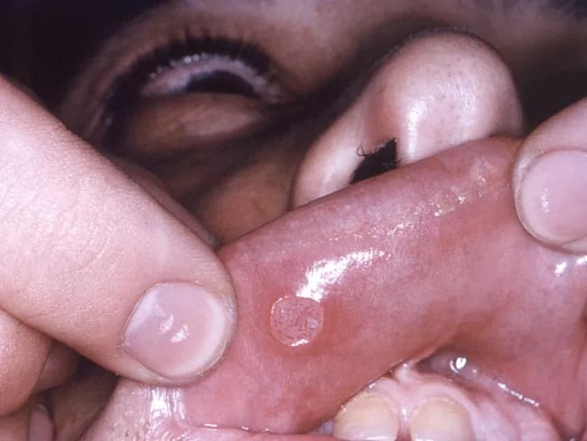 Clinical photograph of an active herpes simplex infection on the lip (herpes labialis). The image demonstrates a localized perioral mucocutaneous lesion. The primary lesion begins as erythematous papules that rapidly coalesce into grouped vesicles; vesicles are fragile, rupture easily, leaving shallow erosions on a reddened (erythematous) base. Some vesicles may appear pustular. The distribution is typically confined to the lips and perioral skin on the vermillion border, consistent with HSV-1 reactivation; seasonal or stress triggers; contagious; high risk of spread via kissing or shared objects. The lesion is often preceded by prodromal tingling or burning. On exam, erythema and swelling may be present; rupture leads to crusting in older lesions. The image is a close-up frontal view of the perioral region, captured with standard clinical photography settings; no contrast agents or staining required. Clinically, herpes labialis is diagnosed by appearance, but PCR or viral culture from vesicular fluid can confirm HSV-1 infection. Differential diagnoses include impetigo, aphthous ulcers, contact dermatitis, and herpes gladiatorum if extraneous sites; management includes antiviral therapy such as acyclovir or valacyclovir, topical analgesics, adequate hydration, and patient education about contagion. This image is useful for education, diagnosis practice, dermatology training, and clinical scenario databases.