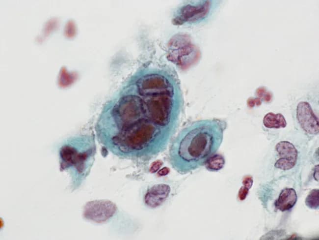 This is a Pap smear cytology image acquired by brightfield light microscopy from the cervix illustrating herpes simplex virus (HSV) infection of cervical squamous epithelium. The focal region shows enlarged squamous cells containing dense eosinophilic intranuclear inclusion bodies with a surrounding clear halo. The chromatin is marginated and peripheral, with pronounced nuclear molding and occasional multinucleation. The virus-induced cytopathic effect yields a characteristic ground-glass nucleus appearance and a perinuclear halo that highlights the inclusion bodies. The cytoplasm is variably basophilic to bluish with keratinized or non-keratinizing squamous differentiation, consistent with Pap-stained cytology. The image demonstrates the classic HSV cytopathic changes, in contrast to cytomegalovirus (owl’s eye) inclusions, which would typically be larger and show distinct perinuclear zones. These features facilitate rapid presumptive diagnosis of HSV cervicitis in a cytology setting, particularly when correlated with clinical symptoms such as genital vesicles or cervicitis with mucopurulent discharge. Confirmation by molecular methods (HSV DNA PCR), viral culture, or direct fluorescent antibody testing can enhance diagnostic accuracy. Clinically, HSV cervicitis is important due to implications for antiviral therapy, sexual health counseling, and consideration of vertical transmission risk in pregnancy. This photomicrograph serves as an educational reference for medical students and cytotechnologists assessing cervicitis cytopathology.