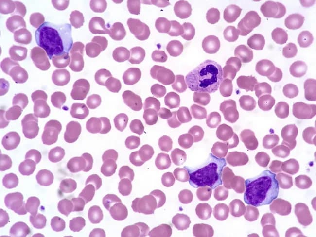 Comprehensive description: This is a brightfield, Wright-Giemsa stained peripheral blood smear examined by light microscopy at high magnification (oil immersion). The specimen shows several activated (atypical) lymphocytes in the peripheral blood, a hallmark of infectious mononucleosis. The lymphocytes have abundant basophilic cytoplasm and irregular, often indented nuclei with clumped chromatin and inconspicuous nucleoli. A normal segmented neutrophil is present for contrast. Erythrocytes exhibit occasional cytoplasmic membrane scalloping around red cells, a feature sometimes observed in EBV-related lymphocytosis. The background cytology is otherwise typical, with uniform erythrocytes and occasional platelets. The activated lymphocytes vary in size and cytoplasmic texture, some appearing plasmacytoid with vesicular basophilia, while others are more indented with coarse chromatin. These morphologic changes reflect an immune response to Epstein-Barr virus infection and are described as reactive lymphocytosis. Clinically, the combination of acute lymphadenitis, fever, a positive Monospot test, and EBV serology supports infectious mononucleosis. The image helps differentiate viral-induced lymphocytosis from bacterial lymphadenitis and from hematologic malignancies when integrated with clinical data. In summary, this smear illustrates the classical hematologic manifestation of EBV-associated mononucleosis. These atypical lymphocytes, sometimes named Downey cells, accompany fever and pharyngitis in EBV infection and aid differentiation from leukemia when combined with serology and clinical data.