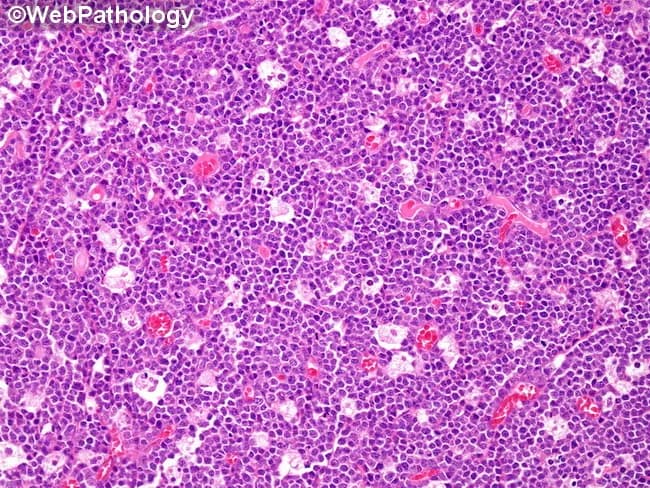 Comprehensive description of Burkitt lymphoma histology. This is a bright-field light microscopy image of an H&E stained lymph node biopsy. The tissue demonstrates the hallmark 'starry sky' pattern produced by numerous pale tingible-body macrophages interspersed among a dense population of medium-sized lymphoid cells. The malignant cells are small to medium with round nuclei, coarse chromatin, multiple small nucleoli, and scant cytoplasm, creating a high nuclear-to-cytoplasmic ratio. Mitotic activity is brisk, contributing to marked cellular turnover. The macrophages ingest apoptotic debris, appearing as clear spaces that resemble stars against a deep blue background of neoplastic lymphocytes. The overall architecture is diffuse, with little stromal preservation, consistent with a high-grade B-cell lymphoma. Immunophenotype is typically CD20+, CD10+, and BCL6+, with a near-100% Ki-67 proliferation index; genetic hallmark is c-MYC translocation, most commonly t(8;14)(q24;q32). Clinically, this pattern is characteristic of Burkitt lymphoma (aggressive non-Hodgkin lymphoma) and guides rapid, intensive chemotherapy. The image supports differential considerations including diffuse large B-cell lymphoma and lymphoblastic lymphoma; however, the starry-sky morphology remains highly specific in context. This description is relevant for medical education, pathology teaching, and research datasets to illustrate classic Burkitt histology, high-grade lymphoid neoplasia, and the diagnostic utility of abundant tingible-body macrophages.