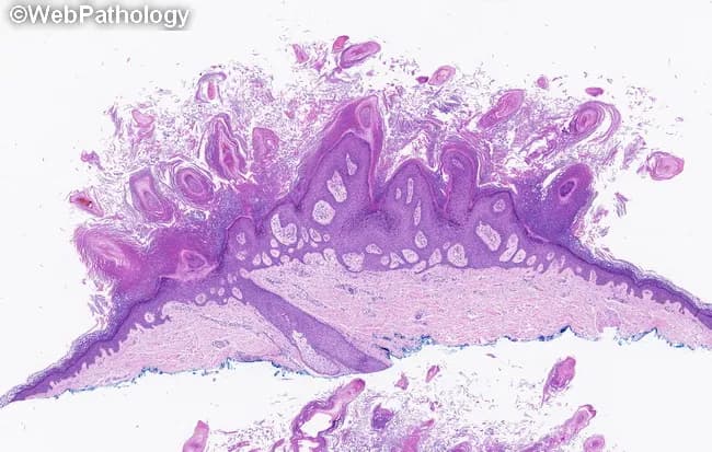 Histopathology of a cutaneous verruca vulgaris (common wart) demonstrated on a hematoxylin and eosin stained skin biopsy. The specimen shows an exophytic, cauliflower-like lesion arising from the epidermis with marked epidermal hyperplasia. Papillomatosis is evident as elongation and upgrowth of the rete ridges with surface projections. Acanthosis is present with diffuse thickening of the squamous cell layer; hyperkeratosis with parakeratosis is observed at the lesion surface, reflecting aberrant keratinization. Filiform papillae extend from the surface and end in finger-like projections. The dermal interface is relatively thin with a sparse inflammatory infiltrate and preserved dermal connective tissue. There is no obvious dysplasia or invasion. The histologic pattern is characteristic for HPV-induced verruca vulgaris, though koilocytosis (perinuclear halos in squamous cells) may be variably present and not always conspicuous in all sections. This morphology supports diagnosis of a benign, HPV-associated cutaneous wart rather than a corn, seborrheic keratosis, or other hyperkeratotic lesion. Clinically, verruca vulgaris presents as discrete, rough, hyperkeratotic papules or plaques on exposed or non-exposed skin, commonly in children and young adults. The diagnostic significance lies in recognizing papillomatosis with acanthosis and parakeratosis as classic features, guiding management such as topical therapies, cryotherapy, or surgical removal and reducing misdiagnosis with keratotic lesions.