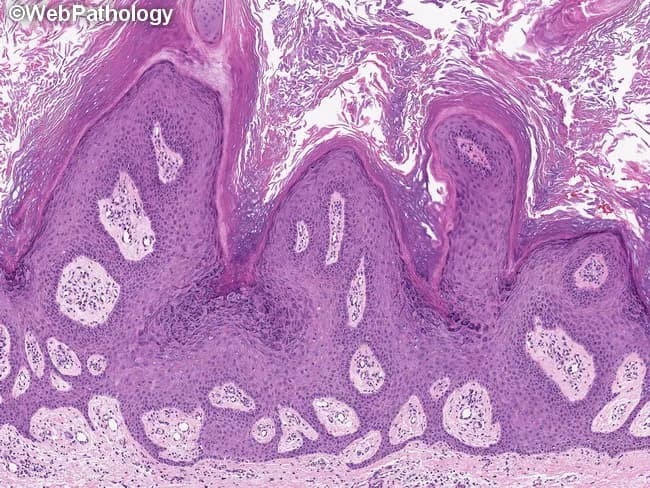 Histopathology of a common cutaneous wart (verruca vulgaris) on a routine hematoxylin and eosin stained skin biopsy. Imaging modality: Light microscopy of a skin biopsy with standard H&E staining. The epidermis shows marked hyperplasia with broad acanthosis and pronounced papillomatosis, producing a corrugated, exophytic surface. Hyperkeratosis with focal parakeratosis is evident at the tips of the projections. Rete ridges extend downward in elongated, serpiginous fashion. Filiform or finger-like papillary extensions project into the dermis with narrow dermal cores. Infected keratinocytes exhibit koilocytosis: enlarged, pale nuclei with perinuclear halos, a hallmark of HPV-related cytopathic effect. The underlying dermis shows mild chronic inflammation without deep invasion. Together, these features define verruca vulgaris and help distinguish it from verruca plana and other papillary lesions. Diagnostic significance: HPV-induced epidermal hyperplasia with papillomatosis and koilocytosis is characteristic; supports clinical diagnosis of a common wart. Differential considerations include verruca plana, seborrheic keratosis, keratoacanthoma, and cutaneous horn. Clinical correlation: rough, hyperkeratotic papules on exposed or frequently traumatized skin, commonly on hands and fingers; treatment options include cryotherapy, salicylic acid preparations, immunotherapy, and recurrence risk is moderate. Correlation with clinical morphology strengthens diagnostic confidence and guides targeted destructive therapies.