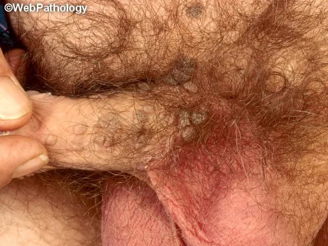 This gross clinical photograph shows external genital warts (condylomata acuminata) arising from the penile shaft and adjacent pubic skin. The image demonstrates multiple raised, flesh-colored papules with a rough, keratotic surface, arranged in clusters along the hair-bearing genital skin. The lesions are exophytic and papillomatous, measuring a few millimeters to over a centimeter in greatest dimension, with subtle erythema at the base and no obvious ulceration or drainage. The appearance is characteristic for HPV-induced genital warts, most commonly caused by HPV types 6 and 11, though other oncogenic types (2, 16, 18, 31, 33, 35, 39, 45, 51–56, 59) can be involved. Clinical diagnosis is supported by the typical morphology: verrucous, pink-to-flesh-colored papules that may coalesce into plaques. In the absence of histology, koilocytosis and epithelial hyperplasia would be expected on biopsy. Transmission is via sexual contact with minor trauma; autoinoculation and concurrent sexually transmitted infections may occur; incidence is higher in sexually active adults aged 20–40. The image is useful for educational illustration, differential diagnosis with verruca vulgaris and condyloma lata, and for teaching clinicians to recognize HPV-related anogenital lesions and counsel patients regarding treatment and prevention. Management considerations include topical therapy, ablative options, and vaccination discussion with patients.