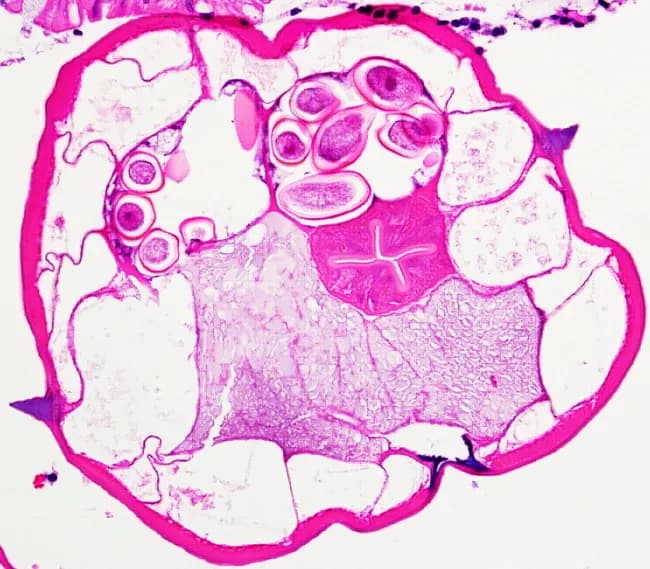 This cross-sectional light microscopy image depicts a female Enterobius vermicularis (pinworm) in transverse section within gastrointestinal tissue, stained with Hematoxylin and Eosin (H&E). The specimen shows a circular host cross-section containing a coiled nematode with pronounced lateral alae (alae) along the cuticle, a hallmark feature for identification. In the worm body, clear internal organs are visible, including a central digestive tract and reproductive structures; within the uterus numerous eggs are evident as operculated or oval, densely packed entities. The surrounding mucosa and submucosa reflect intestinal tissue with wavy smooth muscle layers and extracellular matrix; the thick, pink-stained cuticle of the nematode contrasts with the eosinophilic cytoplasm of the worm's parenchyma and the surrounding host tissue. The eggs within the worm body are ovoid, often deeply basophilic with visible shells in some sections. Notable features include the characteristic lateral alae (alae) extending along the dorsal and ventral surface and the presence of numerous eggs in the uterus, indicative of female pinworms producing eggs. Clinically, this image supports diagnosis of enterobiasis; pathologists correlate with perianal itching history and stool or cellophane tape test results. This slide is a valuable teaching reference for parasitology, histopathology and tropical medicine laboratories.