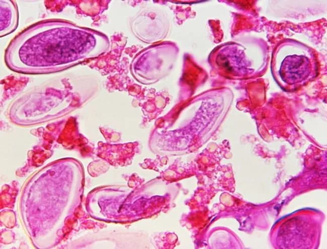 This is a bright-field light microscopy image of Enterobius vermicularis eggs (pinworm) obtained from a fecal or perianal specimen. The eggs appear as elongated, ovoid ova with a characteristic flattened side, stained pink-purple against a pale background. Measurements within the field confirm the diagnostic morphology: eggs approximately 50–60 μm long by 20–32 μm wide, consistent with standard parasitology references. The shells are thick and smooth, with a distinct taper and a subtly curved outline in many specimens. A perianal sediment of particulate material and host cells is visible, illustrating typical background in stool or tape-prep preparations. Clinically, the detection of these eggs is highly specific for Enterobius vermicularis infection and supports a diagnosis in patients with nocturnal perianal itching or observed scratching, especially in children with close-contact exposure. Differential considerations include eggs of other helminths such as Ascaris lumbricoides or Trichuris trichiura, which differ in size, shape, and shell ornamentation. The image’s diagnostic significance lies in enabling rapid identification and differentiation from artifacts in educational and clinical laboratory settings. Its CDC provenance (Dr. George R. Healy) makes it a trusted reference for teaching parasitology, epidemiology, and diagnostic parasitology workflows. This image supports education, proficiency testing, and reference material for parasitology laboratories.