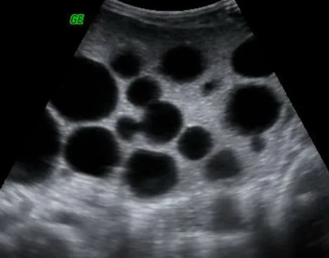 Ultrasound imaging of the peritoneal cavity demonstrates multifocal cystic lesions with well defined circular margins. The predominant appearance is multiple anechoic to hypoechoic spheres, varying in size from a few millimeters to several centimeters, with posterior acoustic enhancement and minimal internal echoes. The lesions are scattered across the peritoneal surfaces, consistent with peritoneal hydatidosis, most likely secondary to rupture or spillage from hepatic hydatid cysts; primary peritoneal hydatidosis is rare. In this case, the pattern supports secondary dissemination due to hepatic disease; the appearance may include daughter cysts and serpiginous internal septations in some cysts, creating a "cluster of grapes" or "wheel spoke" configuration. The sonographic findings correlate with echinococcosis: cysts may remain nonviable or contain viable protoscoleces, depending on host response. There is no confirmed solid nodularity or ascites; vascularity on Doppler is typically minimal. Clinically, this imaging finding suggests parasitic infection by Echinococcus species; the diagnostic significance lies in risk stratification for anaphylaxis on antigen release and in planning antihelminthic therapy (albendazole, mebendazole) and possible surgical intervention. Differential considerations include peritoneal carcinomatosis, mucinous peritoneal implants, and other cystic peritoneal diseases. Correlation with liver imaging and serology is recommended for comprehensive management. Further imaging and serology will guide therapy.