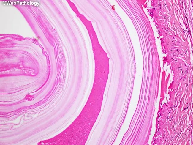 Histology, light microscopy, stained with Hematoxylin and Eosin, of a hydatid cyst wall illustrating classic parasite-host architecture. The outer laminated membrane appears as a thick, eosinophilic, acellular layer, enclosing the cyst cavity. Beneath it lies the germinal or germinative layer, a cellular, irregular lining responsible for generation of infectious components. The germinal layer produces brood capsules, which in turn contain multiple scolices equipped with rostellar hooks. The scolices may be seen within the brood capsules, or detached in the surrounding cyst fluid as hydatid sand. The host tissue shows minimal inflammatory response in uncomplicated disease, though a surrounding fibrous capsule or pericyst may be visible in some specimens. The combination of laminated membrane, fragile germinal epithelium, and scolices with hooklets is highly diagnostic for echinococcosis caused by Echinococcus granulosus (unilocular hydatid disease); Echinococcus multilocularis produces a more infiltrative lesion with smaller vesicles. This image highlights the key histopathologic features: cyst wall with layers, brood capsules, scolices, hooklets, and occasional daughter cysts. Clinically, such findings confirm hydatid disease and guide management decisions, including antiparasitic therapy, surgical or percutaneous interventions. This image is valuable for parasitology education, surgical pathology, radiology correlation, and graduate-level medical training in infectious diseases and pathology.