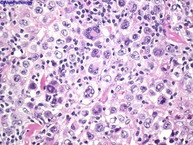 This high-power light micrograph of a lymph node biopsy, stained with Hematoxylin and Eosin, demonstrates classical Hodgkin lymphoma histology. The tissue is densely cellular with a polymorphic inflammatory background comprising small lymphocytes, eosinophils, plasma cells, and histiocytes. Scattered among the background are large binucleated Reed-Sternberg (RS) cells exhibiting prominent, mirror-image eosinophilic nucleoli and ample cytoplasm, giving an owl's eye appearance. Mononuclear RS variants with similar nuclear features are present, reflecting heterogeneity within the malignant cell population. The RS cells may appear with delicate nuclear membranes and occasional lobulation. The surrounding milieu often includes reactive T-lymphocytes and occasional eosinophils attracted by cytokines produced by RS cells. The overall architecture lacks well-formed nodules, and the background shows a mixed inflammatory infiltrate, characteristic of classical Hodgkin lymphoma subtypes such as mixed cellularity. Important differential considerations include infectious or benign reactive processes, but the presence of RS cells with classic morphology supports a diagnosis of classical HL. Clinically, these findings correlate with nodal enlargement and B symptoms in many patients, and histology guides staging and therapy decisions, including chemotherapeutic regimens such as ABVD and potential radiotherapy in select cases. Correlation with immunohistochemistry and clinical data improves diagnostic confidence and treatment planning for patient care.