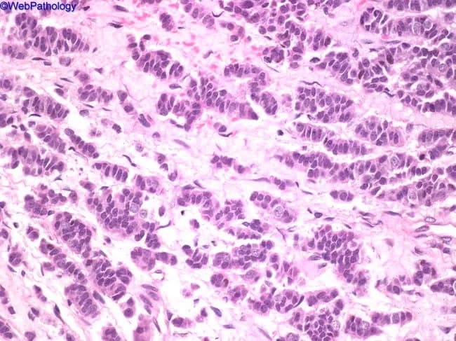 This is a thymic neuroendocrine tumor (thymic carcinoid) represented on a hematoxylin and eosin stained histology slide prepared from thymic tissue. The specimen is a thymic lesion in the anterior mediastinum. The tumor displays organoid nesting and ribbon-like arrangements (zellballen/perivascular rosettes) of uniform small cells with round to oval nuclei, finely dispersed chromatin (salt-and-pepper appearance), and scant cytoplasm. Cells are densely packed in interlacing cords and fascicles with delicate fibrovascular stroma; mitotic figures are infrequent in this field; necrosis is not conspicuous. The image shows a cohesive neuroendocrine morphology with minimal pleomorphism and absence of overt squamous differentiation. Immunophenotype in practice would be positive for neuroendocrine markers (chromogranin A, synaptophysin) and cytokeratins, supporting thymic carcinoid. The differential diagnosis includes spindle cell thymoma (type A) when spindle cells predominate, paraganglioma, medullary thyroid carcinoma with amyloid stroma, metastatic mucinous adenocarcinoma, and angiomatoid variants mimicking hemangioma. Clinically, thymic carcinoids are aggressive, may recur or metastasize, and require surgical excision with possible adjuvant therapy. This image is relevant for educational purposes in surgical pathology, mediastinal tumors, and neuroendocrine tumor biology, enabling recognition of organoid nesting, ribbon/festoons growth, salt-and-pepper chromatin, and differential with thymic spindle tumors and paragangliomas. High clinical relevance for diagnosis and management.