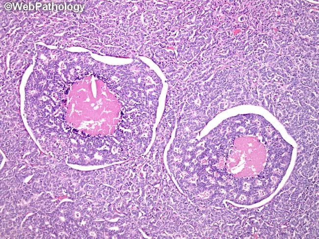 Histology image: Light microscopy of a formalin-fixed paraffin-embedded tissue section stained with Hematoxylin and Eosin reveals features consistent with an atypical carcinoid tumor, a pulmonary neuroendocrine neoplasm. Tumor cells are arranged in nests and sheets with occasional trabecular patterns, showing organoid architecture typical of neuroendocrine neoplasms. The cells are round to polygonal with moderate cytoplasm and nuclei displaying mild to moderate pleomorphism; chromatin may show a salt-and-pepper appearance. Notable features include focal necrosis and an elevated mitotic rate, defined here as 2–10 or more mitoses per high-power field, which supports the atypical designation over typical carcinoid. Calcifications can be present as small basophilic foci within tumor nests. The overall pattern is relatively cohesive with limited invasion into the surrounding stroma in this field. These histologic characteristics—neuroendocrine differentiation, organoid nesting, increased mitotic activity, and necrosis—confer clinical significance by indicating at least an intermediate-grade tumor with higher potential for metastasis compared to typical carcinoid. Clinically, this information informs prognosis and guides management decisions, including consideration of surgical resection and assessment for adjuvant therapy based on stage and grade. Differential diagnosis includes typical carcinoid, small cell lung carcinoma, and large cell neuroendocrine carcinoma within the pulmonary neuroendocrine tumor spectrum.