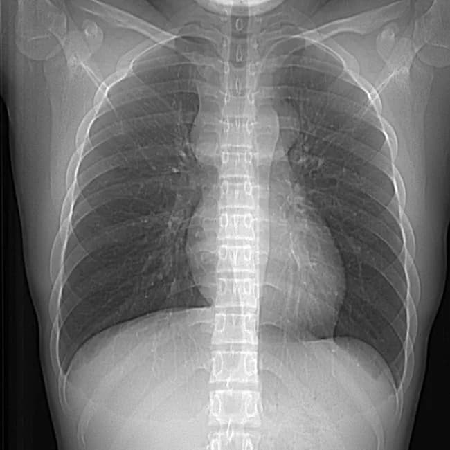 Chest radiograph, pediatric patient, frontal view, single projection. Modality and technique: Chest X-ray (Radiography) performed with standard anteroposterior projection. The mediastinal contours show a rounded, well-defined anterior mediastinal mass projecting over the silhouette. The lesion appears intrathoracic and anterior to the heart, with the descending aorta visible coursing through or behind it, suggesting an anterior mediastinal origin. Cardiomediastinal silhouette mildly displaced but overall within normal size for age. The lungs are perihilar and peripheral fields clear without focal consolidation or effusion. No pneumothorax. The image is compatible with a mediastinal germ cell tumor, specifically a teratoma, given the location and radiographic appearance; however, radiography cannot reliably distinguish histology. In pediatric mediastinal masses, anterior compartment tumors such as thymic lesions, lymphoma and germ cell tumors are in the differential. Radiologic correlation with computed tomography or magnetic resonance imaging is recommended to characterize internal components (fat, calcifications, cystic areas) and assess vascular relations. The case as described corresponds to a mediastinal teratoma, often seen as a rounded, heterogeneous anterior mass that may contain calcifications and fat-density elements. Diagnosis has clinical relevance for surgical planning and prognosis; pathology typically reveals mature or immature teratomatous elements; treatment is surgical excision. Relevant for radiology education and case-based review.