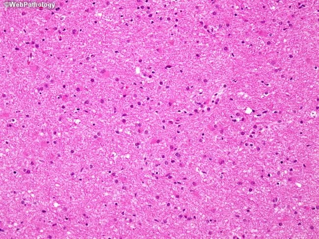Imaging modality: light microscopy of a hematoxylin and eosin stained brain tissue section from a cerebral hemisphere tumor. Primary subject: diffuse astrocytoma, WHO Grade II (infiltrating astrocytoma). Specimen: brain parenchyma/tumor tissue. Imaging perspective: microscopic histology field. Anatomical context: central nervous system, brain (cerebral hemispheres), intra-axial glial neoplasm displaying diffuse infiltration. Visual features: moderately increased cellularity with mildly enlarged, variably hyperchromatic nuclei; mild nuclear pleomorphism; delicate, interconnected astrocytic processes creating a fibrillary background; abundant eosinophilic cytoplasm in some astrocyte-like cells; absence of overt necrosis or microvascular proliferation in this field; mitotic activity not evident at this magnification. Pathology: low-grade, infiltrative glioma consistent with WHO Grade II astrocytoma; preserves overall brain architecture; growth pattern extraparenchymal infiltration challenging complete resection; lacks features defining higher grades (no brisk mitoses, microvascular proliferation, or necrosis). Diagnostic significance: confirms low-grade astrocytic neoplasm; implications for prognosis and management; potential progression to higher-grade gliomas (III–IV) with time or treatment resistance; imaging correlation with MRI typically demonstrates non-destructive, infiltrative lesion; informs surgical planning, adjuvant radiotherapy/chemotherapy decisions; differential considerations include oligodendroglioma and pilocytic astrocytoma in specific contexts. Clinical relevance: presents with seizures/ focal deficits in adults (4th–6th decades), guiding neuro-oncologic workup and longitudinal surveillance. This image exemplifies low-grade glial tumor histology.