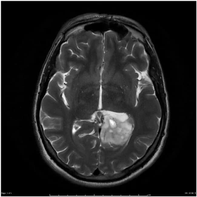 Magnetic Resonance Imaging (MRI) of the brain, axial plane, with gadolinium contrast, including post‑contrast T1-weighted sequences and accompanying T2/FLAIR imaging. A left occipito‑temporal intra-axial mass is evident, showing irregular, ill‑defined enhancement after contrast with surrounding vasogenic edema and mild mass effect on adjacent cortex and sulci. The radiographic phenotype is most compatible with an infiltrative glial neoplasm of intermediate to high grade, with differential diagnosis including anaplastic astrocytoma versus glioblastoma. Perfusion or spectroscopy data (not shown) would further aid grading and treatment planning. The patient underwent surgical resection. Histology demonstrated astrocytic tumor cells with increased cellularity, nuclear pleomorphism, and brisk mitotic activity, without definitive necrosis, consistent with anaplastic astrocytoma (WHO Grade III). Location in the left occipito‑temporal region correlates with potential language and visual processing effects and explains seizure propensity. Imaging features—irregular enhancement, infiltrative margins, edema, and no definite necrosis—support high‑grade designation, though overlap with Grade IV lesions exists. Clinically, these tumors are managed with maximal safe resection followed by radiotherapy with concomitant and adjuvant temozolomide; MGMT status may influence prognosis. This case exemplifies imaging‑pathology correlation in adult supratentorial gliomas and informs differential diagnosis, surgical planning, and oncologic management discussions for neuroradiology, neuro-oncology, and neurosurgical trainees. Case courtesy of Radiopaedia, Dr. Frank Gaillard.
