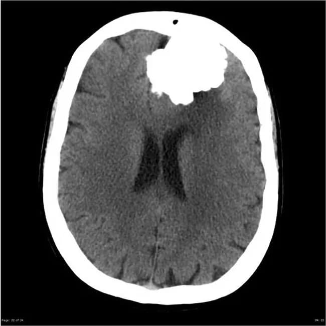 Imaging modality and technique: Non-contrast CT of the brain is the primary image, with axial sections demonstrating a well circumscribed, extra-axial mass located at the anterior cranial fossa near the frontal convexity. The lesion is markedly hyperdense due to dense calcification, with coarse calcifications producing bright foci that obscure the underlying cortex. The mass abuts the dura and appears to cause mild mass effect on the adjacent frontal lobes, but there is no midline shift or intraventricular hemorrhage. The appearance is classic for a calcified meningioma; the tumor originates from the dura and demonstrates dural-based expansion, with a possible dural tail on the MRI counterpart. The MRI image (not shown here) would typically show a lesion with variable T1/T2 signal and strong, homogeneous enhancement after gadolinium, consistent with meningioma and predominance of calcified components. Clinically, incidental discovery of a calcified meningioma aligns with a slow-growing, benign meninges-derived neoplasm. Differential considerations include psammomatous meningioma, calcified oligodendroglioma (intra-axial), calcified metastasis, and dural-based schwannoma; however, location and extra-axial behavior with dense calcifications favor meningioma. Diagnostic significance is that surgical resection often yields cure; prognosis depends on size, location, edema, and invasion; radiologic monitoring is advised.