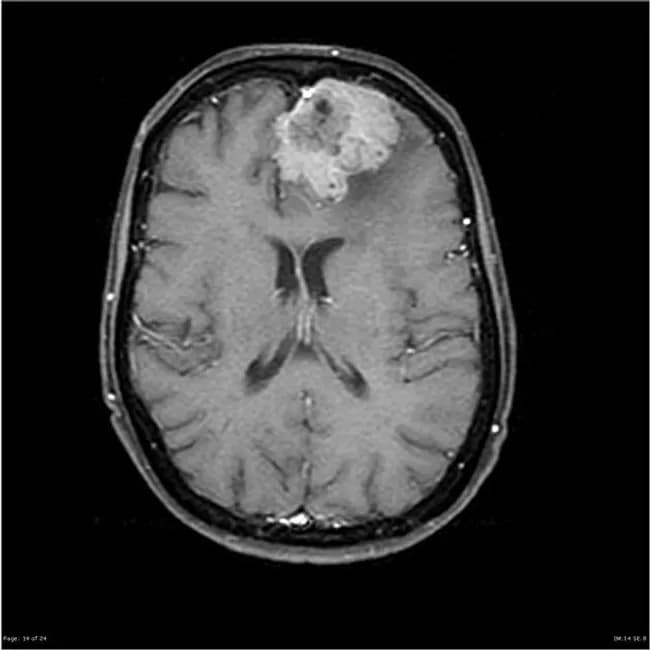 MRI with gadolinium contrast (Magnetic Resonance Imaging, post-contrast T1-weighted sequences) reveals a large extra-axial, dural-based mass projecting from the convexity of the frontal/temporal lobes. The lesion abuts the dura with an irregular but well-circumscribed silhouette and demonstrates intense, homogeneous enhancement after gadolinium administration. On axial images the mass displaces adjacent cortex and may produce mild peritumoral edema without invading the underlying brain parenchyma; a classic dural tail may be present though not required for diagnosis. The imaging pattern is typical for meningioma: a slow-growing, benign intracranial tumor arising from arachnoidal cap cells; the size can reach considerable extent in “silent” regions of cortex. Correlating histology from biopsy or resection shows meningothelial cells arranged in whorls with psammoma bodies; no evidence of brain invasion supports WHO grade I meningioma. Diagnostic significance: post-contrast, uniformly enhancing dural-based lesion with extra-axial location is highly specific for meningioma; radiologic differential includes hemangiopericytoma, dural metastasis, or dural-based schwannoma, but the presence of psammoma bodies is characteristic histology. Clinically, incidental discovery emphasizes that slow-growing meningiomas can attain large size before symptoms; management includes surgical excision with complete or subtotal resection and radiologic follow-up to monitor recurrence. These features guide biopsy decisions and surgical planning.
