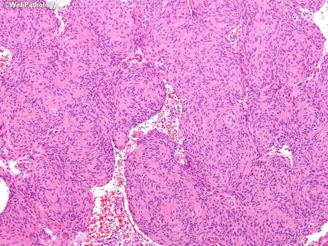 Imaging modality and technique: Light microscopy of Hematoxylin and Eosin (H&E) stained paraffin section from intracranial meningeal tumor tissue. Anatomical context: dura-based CNS neoplasm consistent with meningothelial meningioma. Specimen type: surgical biopsy/resection specimen of a brain/meningeal neoplasm. Primary subject: monomorphic meningothelial cells arranged in cohesive, syncytial sheets and whorls. Visual features: uniform oval nuclei with vesicular chromatin, indistinct cell borders, and scant cytoplasm; overall cellular architecture shows prominent whorled growth with peripherally arranged cells and occasional radial polarity. Background stroma is fibrous with minimal inflammatory infiltrate; psammoma bodies are not conspicuous in this field. Cytologic features are bland, with essentially no mitotic activity evident in this high-power view. Diagnostic interpretation: consistent with a World Health Organization (WHO) grade I meningothelial meningioma, reflecting low proliferative index and benign histology. Differential considerations: transitional or fibrous meningioma variants; metastatic carcinoma is unlikely given cohesive cell groups and meningioma-like whorls. Clinical significance: histopathologic confirmation aids prognosis and guides management after surgical resection. Clinical relevance: relevant for clinical decision-making, imaging-pathology correlation, and research into meningioma subtypes and outcomes. Note that there is no evidence of anaplasia or high grade histologic features such as increased mitotic activity, necrosis, or brain invasion visible in this field, supporting a favorable long term prognosis.