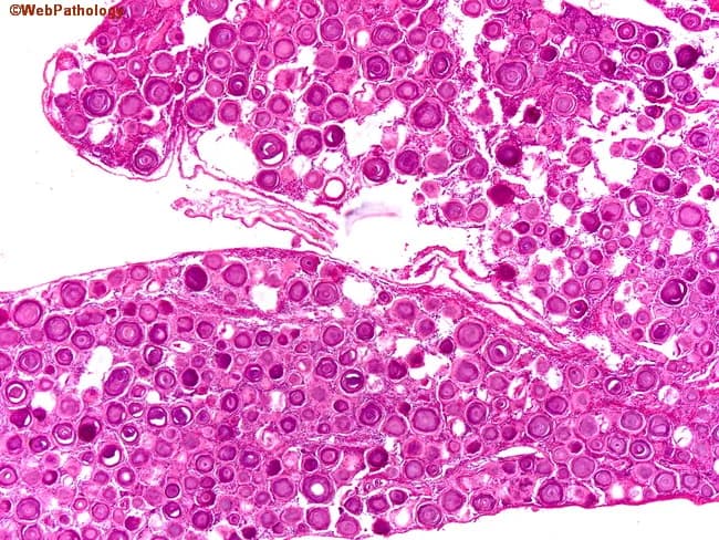 Light microscopy of a spinal meningioma specimen. Imaging modality: histology with Hematoxylin and Eosin staining. The tissue shows classic whorled sheets of uniform meningothelial cells with eosinophilic cytoplasm and oval to vesicular nuclei. Interspersed throughout the tumor are numerous psammoma bodies, concentric laminated calcifications that range from small to large; these calcifications can be basophilic or eosinophilic depending on staining and maturation. The psammomatous variant demonstrates dense sandstone-like lamination within the tumor matrix and occasional focal ossification in advanced foci. The background stroma is fibrous, with low cellular atypia and low mitotic activity, consistent with a benign WHO grade I meningioma. The overall architecture is organized into interrupted lobules and tight cellular whorls arising from meningothelial cells, with abundant extracellular collagen. The presence of multiple psammoma bodies is a diagnostic hallmark distinguishing psammomatous meningioma from other spinal neoplasms. Diagnostic significance: histopathology confirms meningothelial differentiation with psammomatous calcifications; supports a benign prognosis but may cause compressive myelopathy depending on size and location. Clinical correlation: spinal canal mass in older women presenting with progressive myelopathy or radiculopathy; treatment is surgical resection; prognosis is favorable with complete excision; radiologic correlation (MRI) typically shows dural-based enhancement.