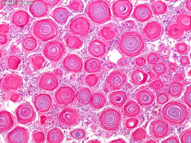 Bright-field histology of an intracranial meningioma shows densely packed meningothelial cells arranged in characteristic whorls and sheets, punctuated by numerous psammoma bodies. In this high-power view, concentric lamellations form calcified, spherical structures of varying size that appear as rings within a pink eosinophilic matrix. The psammoma bodies, composed of laminated calcium deposits, can constitute more than half of the tumor mass in psammomatous meningioma and often obscure the underlying meningothelial component. The surrounding cells display spindle-to-polygonal morphology with indistinct cytoplasmic borders, oval nuclei, and low mitotic activity, consistent with a benign, slow-growing lesion. The calcified nodules are densely eosinophilic and well delineated from the stroma, giving a gritty, laminated appearance. The background stroma is collagenous with occasional microcystic changes; vascularity is variable. This histologic pattern supports a diagnosis of psammomatous meningioma, a histologic variant of meningioma typically classified as WHO grade I. Clinical significance includes a favorable prognosis after surgical resection, with calcification often contributing to a firm, dural-based mass. Differential considerations include other calcified dural-based lesions such as ossified/psammomatous variants and less likely calcified metastases. Immunohistochemical staining would typically reveal EMA and vimentin positivity with keratin negativity, reinforcing meningothelial origin and distinguishing it from glial neoplasms. In practice.