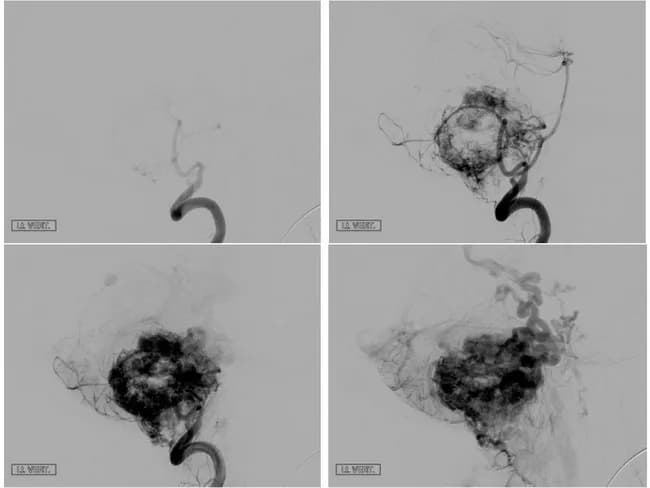 Imaging modality and technique: Cerebral Digital Subtraction Angiography (DSA) with selective vertebral and posterior circulation catheterization, featuring arterial, capillary, and venous phase acquisitions. The study targets a posterior fossa mass, most consistent with a cerebellar hemangioblastoma. The vascular tumor is hypervascular, with prominent feeding arteries and a conspicuous early draining venous plexus. In this case, large feeders arise from the posterior inferior cerebellar arteries and/or other cerebellar branches, producing a pronounced tumor blush that persists through the venous phase as a deep, densely opacified nidus. The peritumoral vessels are tortuous, and draining veins reach the tentorial or straight sinuses through a crowded venous network. The lesion is typically solid-cystic, well circumscribed, and can be extrinsic to the fourth ventricle; however, angiography emphasizes the vascular component. Radiographic differential considerations include other vascular cerebellar tumors such as pilocytic astrocytoma with vascularity and meningioma with sinus involvement in the posterior fossa, though meningiomas are less common in this location. Clinically, cerebellar hemangioblastomas are associated with von Hippel-Lindau syndrome in younger patients and can present with ataxia, headaches, and hydrocephalus from mass effect. The diagnostic significance lies in recognizing the characteristic arteriovenous pattern: multiple feeders, enlarged draining veins, and a deep tumor blush, guiding surgical planning or preoperative embolization decisions.